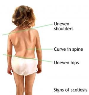 Características posturales de la escoliosis