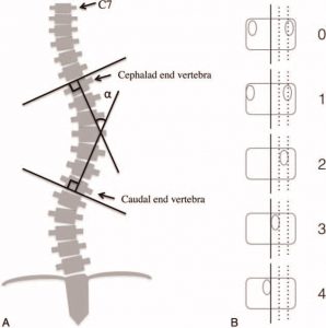 Medición de la escoliosis a través del método radiográfico de Cobb