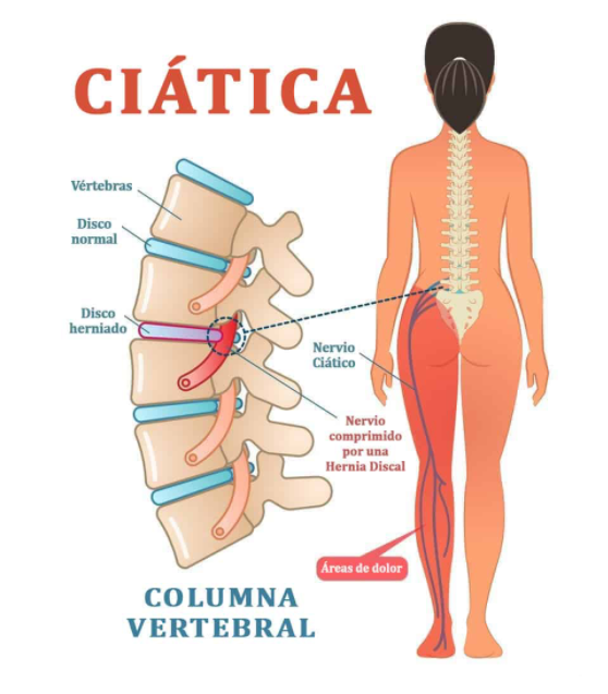 la ciática
